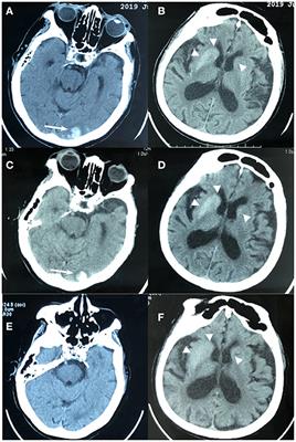 Non-ketotic Hyperglycemia Chorea-Ballismus and Intracerebral Hemorrhage: A Case Report and Literature Review